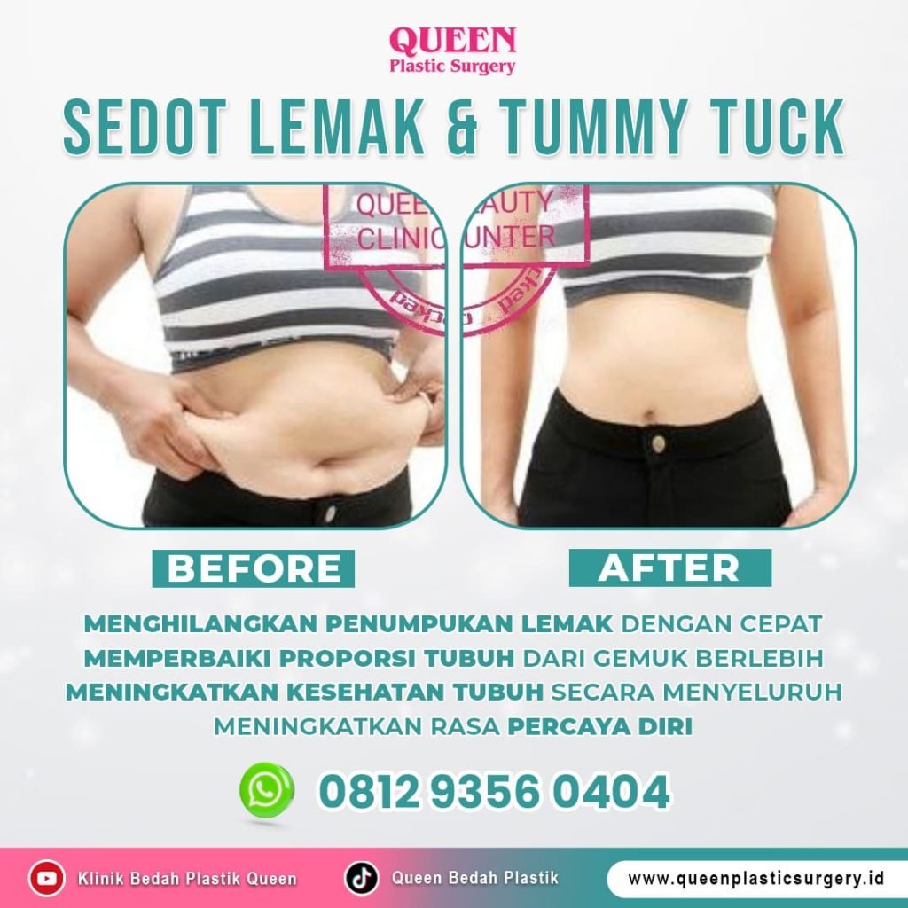 Operasi sedot lemak harga di Queen Plastic Surgery